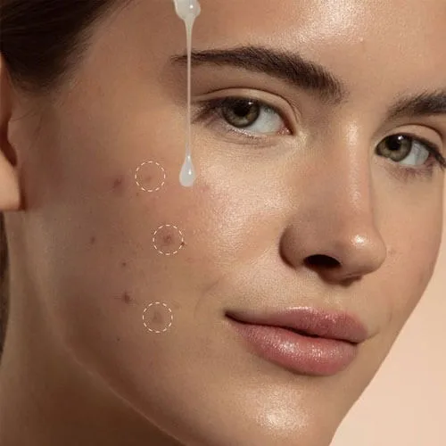 acne-solution-in-islamabad-pakistan